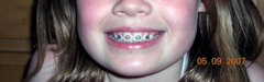 photo of teeth with braces